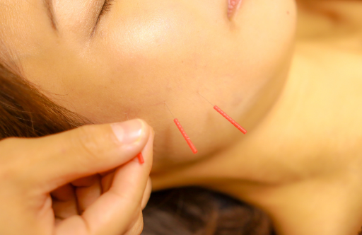 顔に鍼をしている